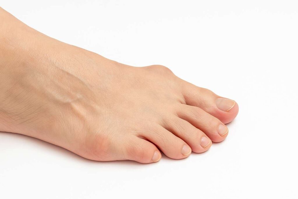 Haluksy – kompleksowy przewodnik po objawach, przyczynach i metodach leczenia